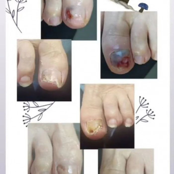 Оніхомікоз