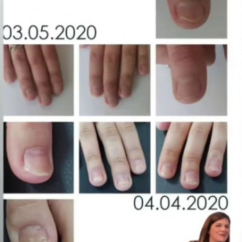 Оніхомікоз