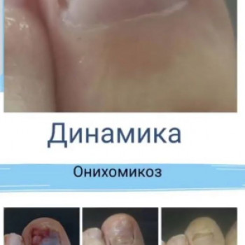 Оніхомікоз