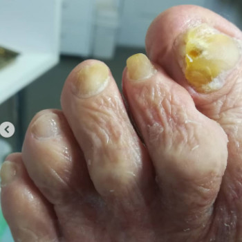 Оніхогрифоз
Після