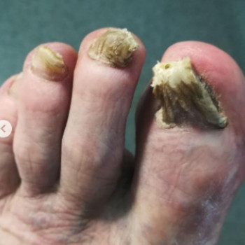 Оніхогрифоз
До