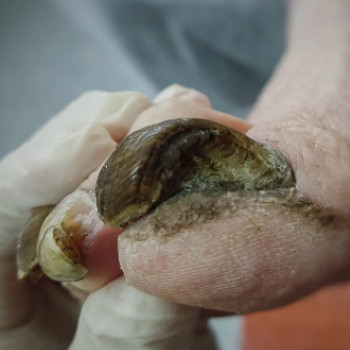 Оніхогрифоз
До
 
 
 
 