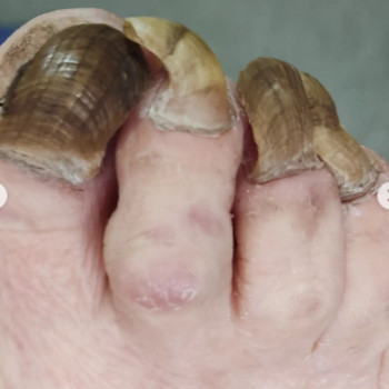 Оніхогрифоз
До
 
 
 
 