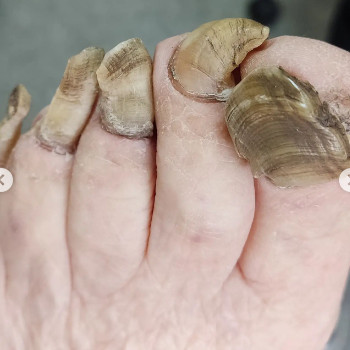 Оніхогрифоз
До
 
 
 
 