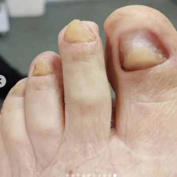 Оніхогрифоз
Після
 
 
 
 