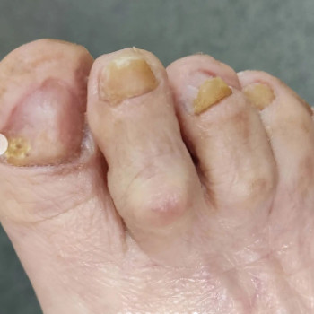 Оніхогрифоз
Після
 
 
 
 