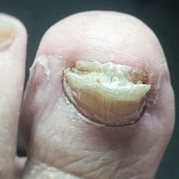 Оніхогрифоз
До
 
 
 
 