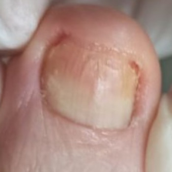 Оніхогрифоз
Після
 
 
 
 