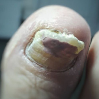 Оніхогрифоз
До
 
 
 
 