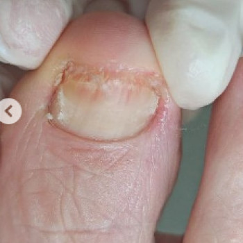 Оніхогрифоз
Після
 
 
 
 