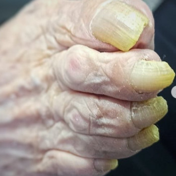 Оніхогрифоз
До
 
 
 
 