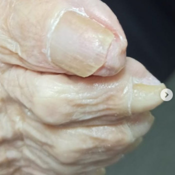 Оніхогрифоз
Після
 
 
 
 