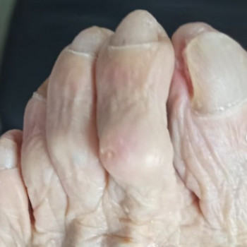 Оніхогрифоз
Після
 
 
 
 