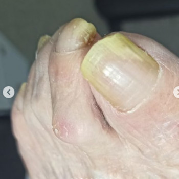 Оніхогрифоз
До
 
 
 
 