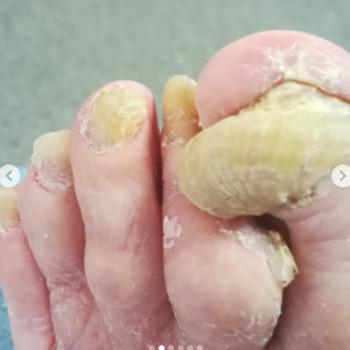 Оніхогрифоз
До
 
 
 
 