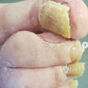 Оніхогрифоз
До
 
 
 
 