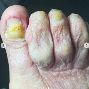 Оніхогрифоз
Після
 
 
 
 