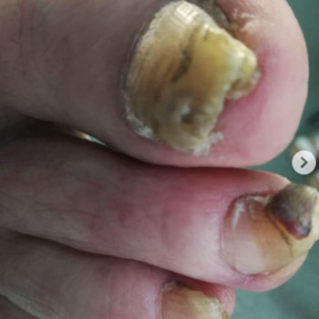 Оніхогрифоз
До
 
 
 
 