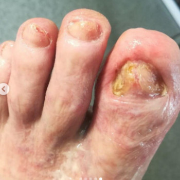 Оніхогрифоз
Після
 
 
 
 