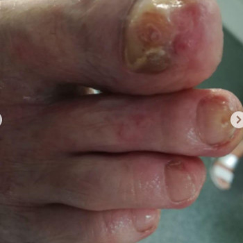 Оніхогрифоз
Після
 
 
 
 