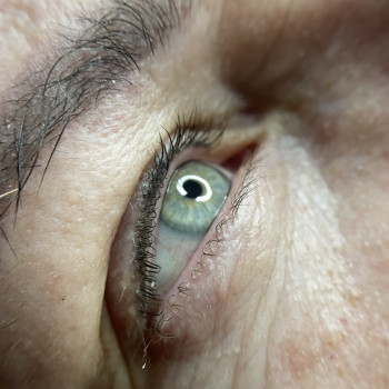 Загоєний перманент міжвійки (одна процедури)