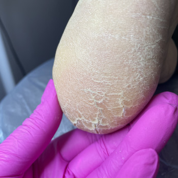 Тріщини на пятах