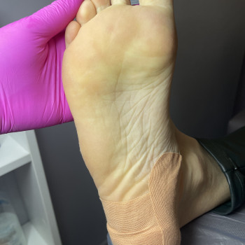 Обробка тріщин з розвантажувальною повязкою