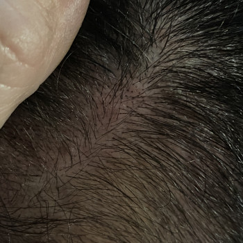 Трихопигментация, SMP