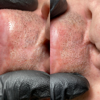 Трихопигментация
                    Мастер перманентного макияжа Анна Киев