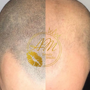 Трихопигментация
                    Мастер перманентного макияжа Анна Киев