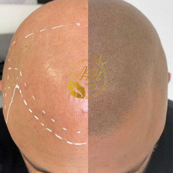 Трихопигментация
                    Мастер перманентного макияжа Анна Киев