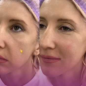 Увеличение губ и контурная пластика лица
                    Косметолог-инъекционист Наталья Одесса