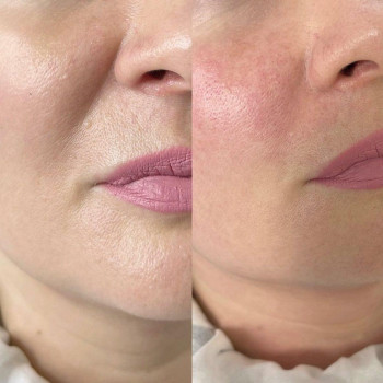 Увеличение губ и контурная пластика лица
                    Косметолог-инъекционист Наталья Одесса