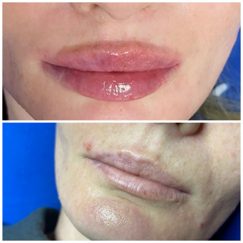 Увеличение губ и контурная пластика лица
                    Косметолог-инъекционист Наталья Одесса