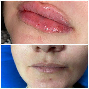 Увеличение губ и контурная пластика лица
                    Косметолог-инъекционист Наталья Одесса