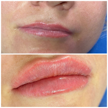 Увеличение губ и контурная пластика лица
                    Косметолог-инъекционист Наталья Одесса