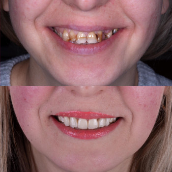 Імплантація та Керамічні коронки, фото - стоматолог Вепа Джумаев