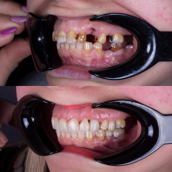 Імплантація та Керамічні коронки, фото - стоматолог Вепа Джумаев