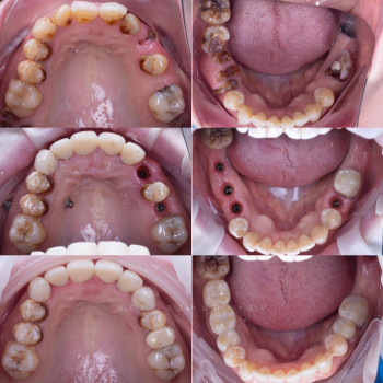 Імплантація та Керамічні коронки, фото - стоматолог Вепа Джумаев