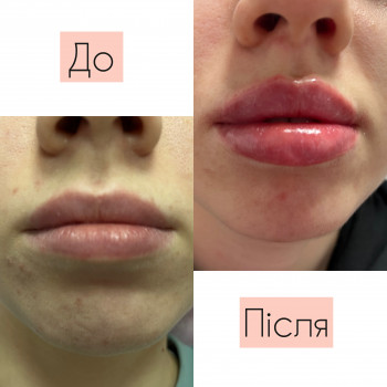 Зволоження губ