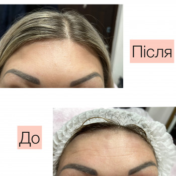 Корекція мімічних зморшок