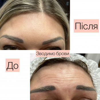 Корекція мімічних зморшок