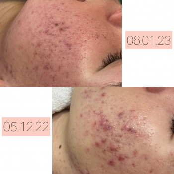Комплексна робота з акне. Проміжковий результат