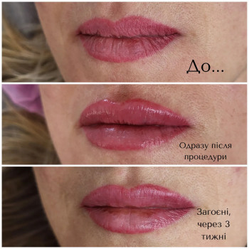 Омоложение губ
Препарат Алекса, 1мл