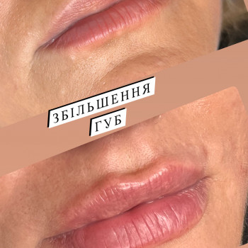 Збільшення губ. Косметологія
                    Тату мастер Анна Коломыя