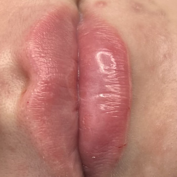 Збільшення губ. Косметологія
                    Тату мастер Анна Коломыя