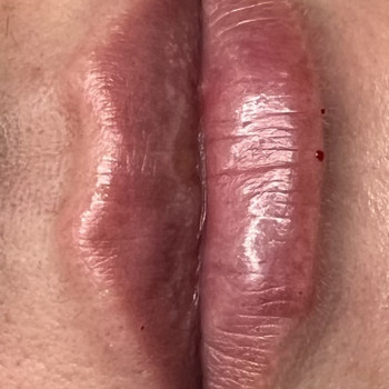 Збільшення губ. Косметологія
                    Тату мастер Анна Коломыя