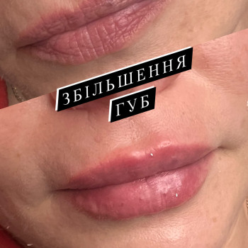 Збільшення губ. Косметологія
                    Тату мастер Анна Коломыя