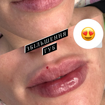 Збільшення губ. Косметологія
                    Тату мастер Анна Коломыя