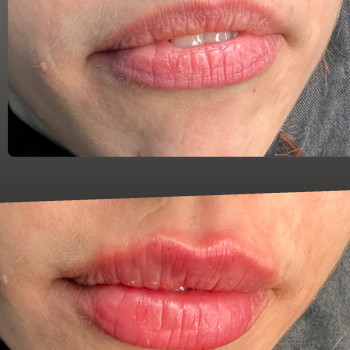 Збільшення губ. Косметологія
                    Тату мастер Анна Коломыя